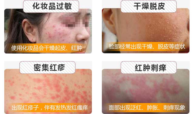 南京肤康过敏性皮炎治疗的误区