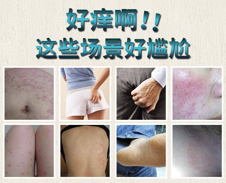 南京肤康皮肤医院牛皮癣患病原因是什么