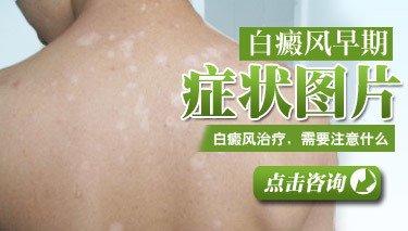 南京肤康皮肤医院白癜风存在着哪些的诱发因素