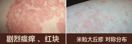 南京肤康皮肤医院湿疹患者的饮食应该如何合理安排？