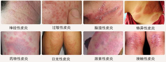 南京肤康皮肤医院皮炎的一些治疗方法