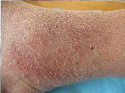 江苏皮肤医院湿疹的发作和什么原因有关