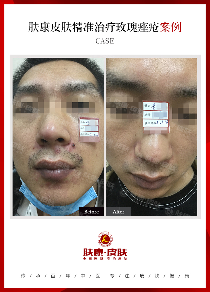 南京肤康皮肤医院痤疮患者的常见症状有哪些？