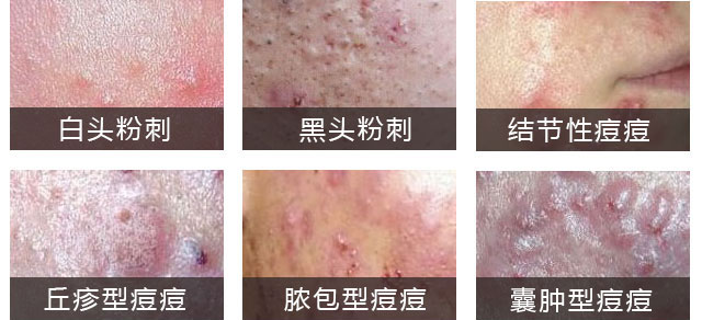 南京肤康皮肤研究所痘痘肌肤如何保养