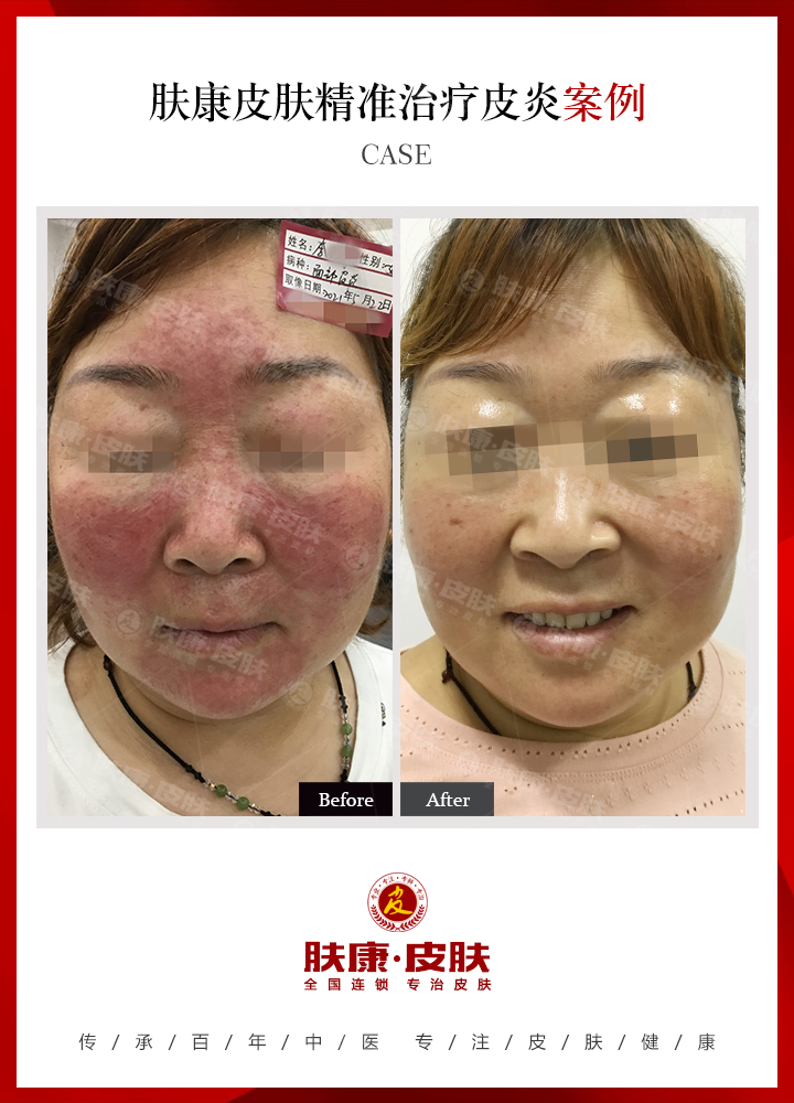 南京肤康皮肤研究所皮炎的种类有哪些