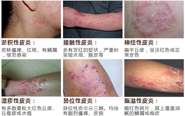 南京肤康皮肤医院皮炎的原因