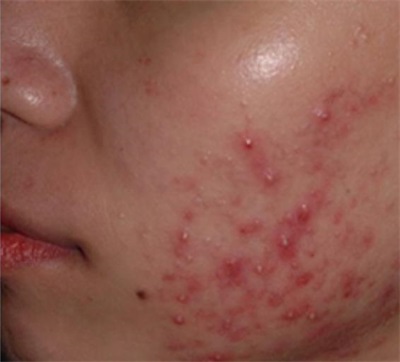 南京肤康皮肤医院预防痤疮的方法有着什么呢
