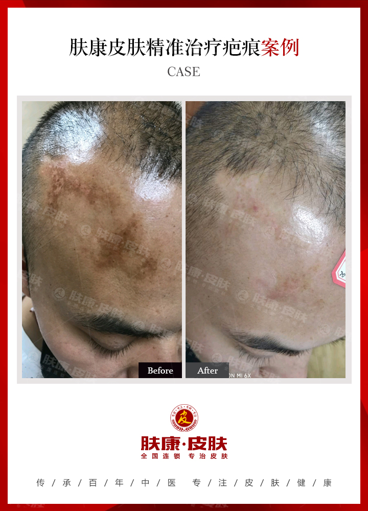 南京肤康皮肤医院脸上有疤痕要注意什么